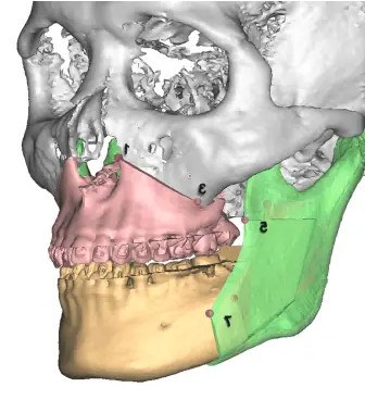 Orthognathic Surgery